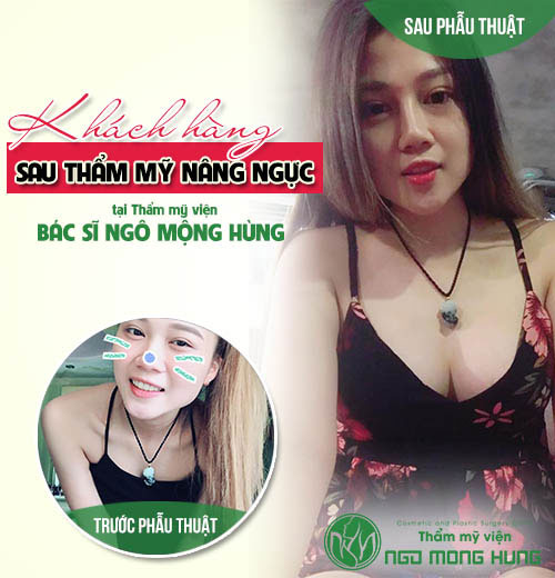 Phẫu thuật nâng ngực an toàn nhất