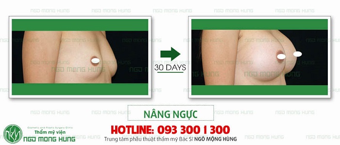 Phẫu thuật nâng ngực có ảnh hưởng gì không