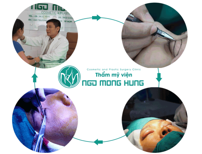 Cắt da thừa mí mắt trên