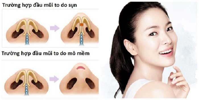 Thu nhỏ đầu mũi như thế nào
