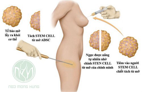 Nâng ngực không cần giải phẫu