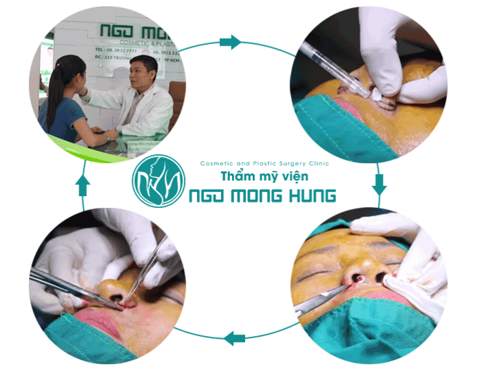 Thu gọn cánh mũi ở đâu đẹp