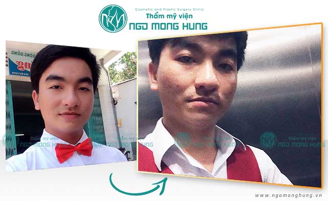 Thu gọn cánh mũi là gì