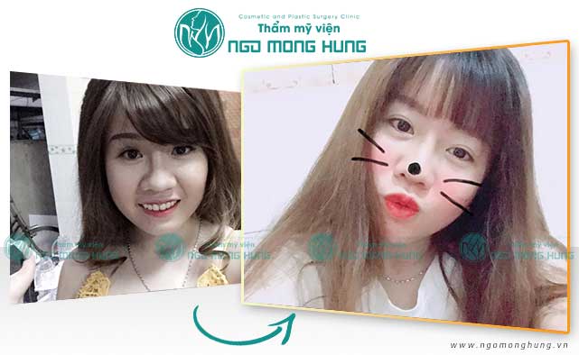 Thu gọn cánh mũi và đầu mũi