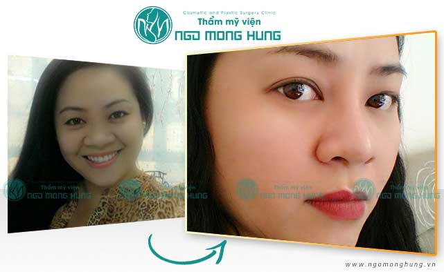 Phẫu thuật thu gọn cánh mũi ở đâu đẹp Phẫu thuật thu gọn cánh mũi ở đâu đẹp
