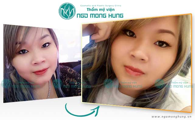 Thu gọn cánh mũi bằng phương pháp nội soi