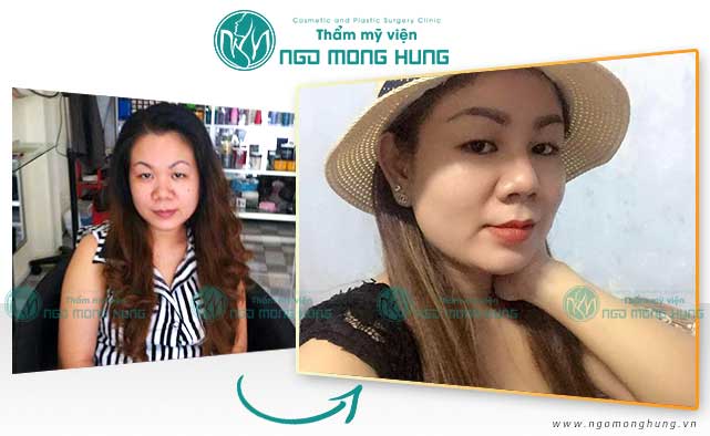 Thu gọn cánh mũi ở đâu đẹp