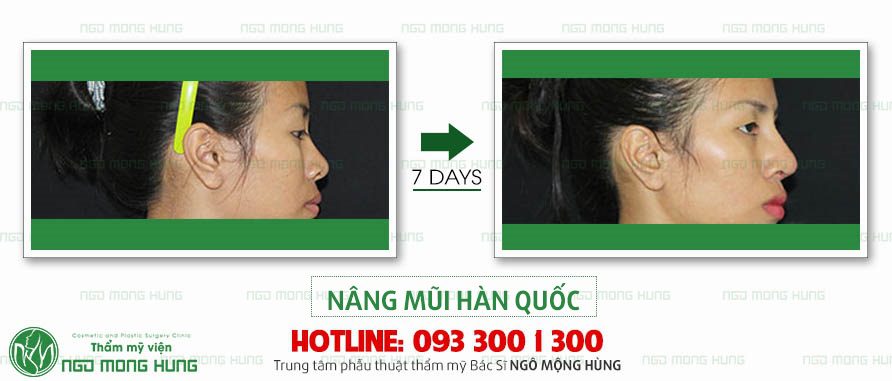 Nâng mũi đổi vận