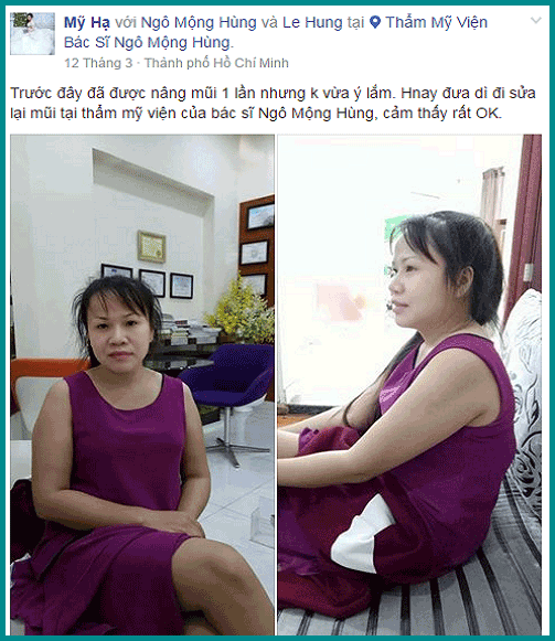 Sửa mũi S Line giá bao nhiêu