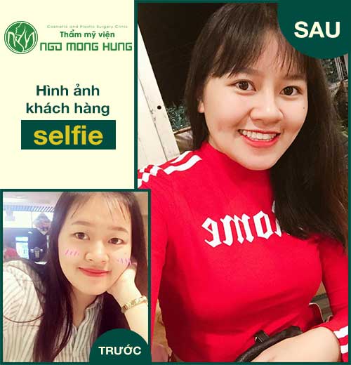 Thu gọn cánh mũi an toàn