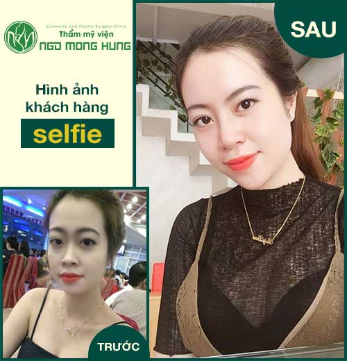Thu nhỏ cánh mũi hết bao nhiêu tiền Thu nhỏ cánh mũi hết bao nhiêu tiền