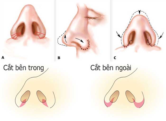 Hình ảnh thu gọn cánh mũi
