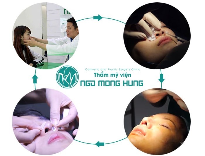 Thu nhỏ đầu mũi ở đâu đẹp