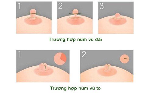 Làm thế nào để thu nhỏ đầu vú