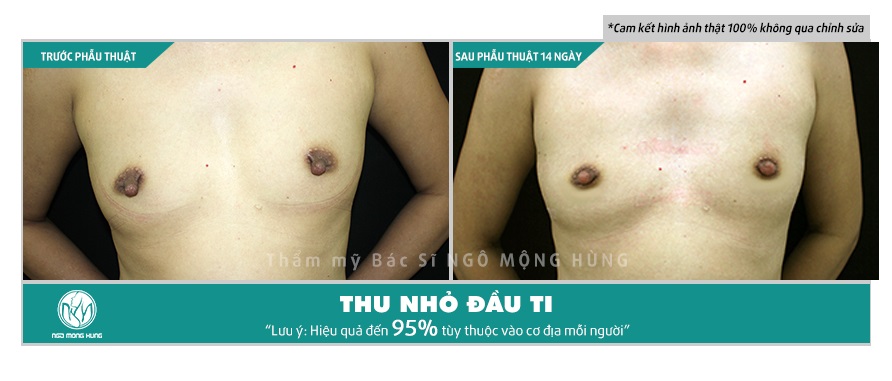 Phẫu thuật thu nhỏ núm vú ở đâu