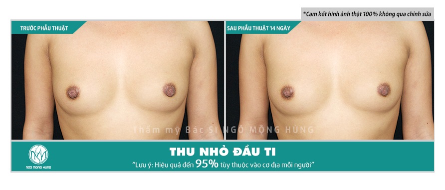 Thu nhỏ núm vú không phẫu thuật