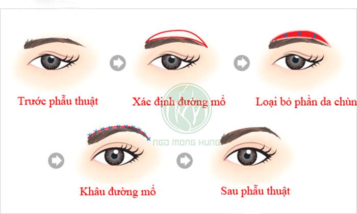 Treo chân mày bằng chỉ