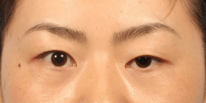 Triệu chứng sụp mí mắt