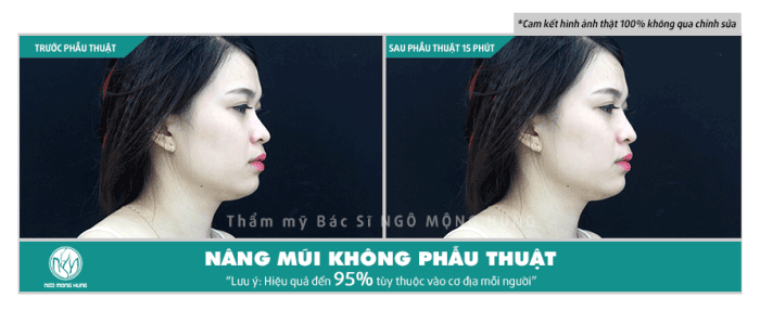 Nâng mũi có đau không