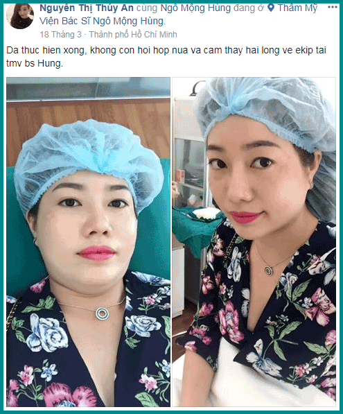 Tạo đôi mắt cười