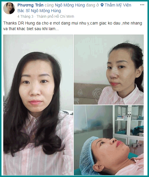 Nâng mũi S Line là sao