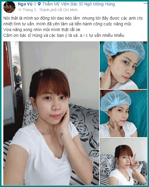Nâng mũi S Line trước và sau