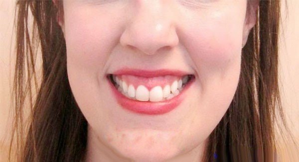 Tiêm botox chữa cười hở lợi
