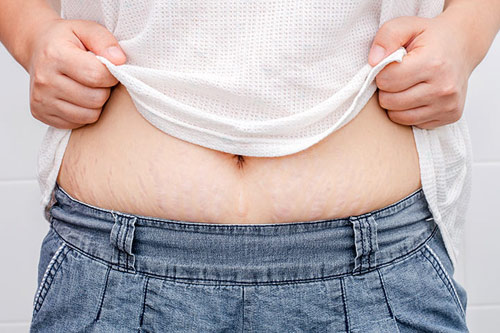 Xóa nhăn da bụng Xóa nhăn da bụng