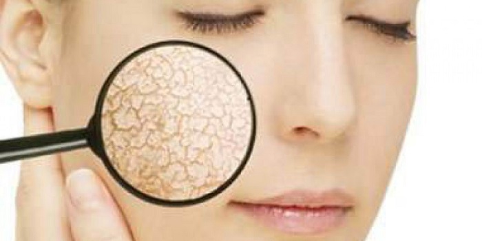 Xóa nếp nhăn bằng chỉ