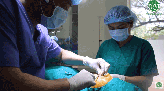Phẫu thuật tạo môi cười