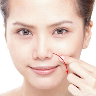 Xóa nếp nhăn rãnh mũi má