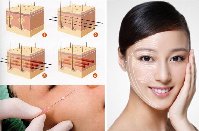 Xóa nếp nhăn giá bao nhiêu Xóa nếp nhăn giá bao nhiêu