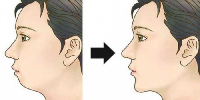 Hình ảnh độn cằm lẹm