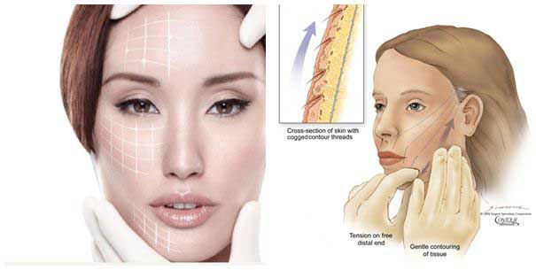 Tìm hiểu về phẫu thuật căng da mặt