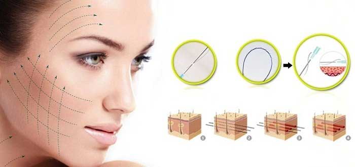 Căng da mặt bằng chỉ có tốt không Căng da mặt bằng chỉ là gì