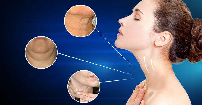 Bí quyết xóa nếp nhăn vùng cổ Bí quyết xóa nếp nhăn vùng cổ