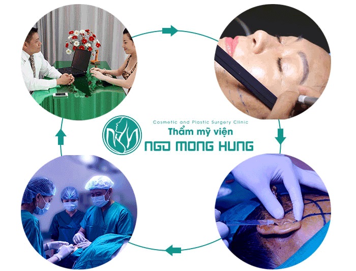 Căng da mặt xóa nếp nhăn