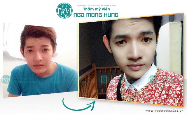 Gọt mặt cho nam