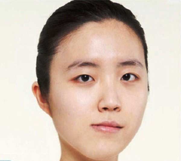 Độn cằm bị lệch