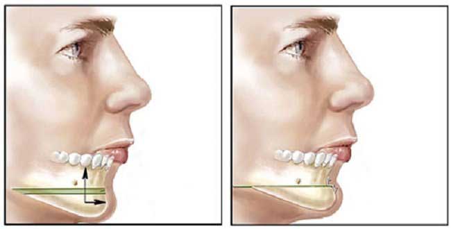 Gọt mặt trượt cằm