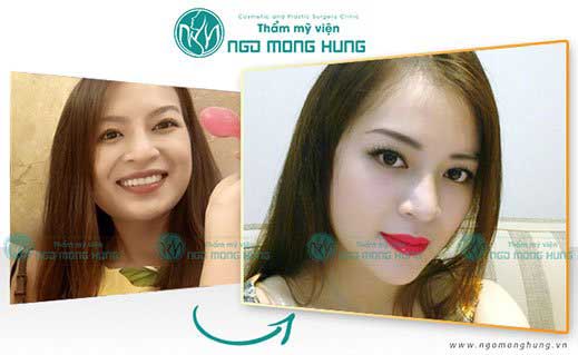 Hạ gò má cao Webtretho