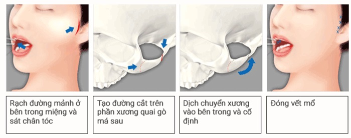 Hạ xương gò má không phẫu thuật