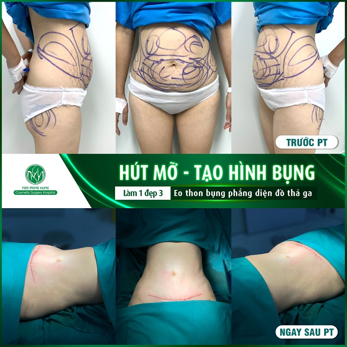 Hút mỡ bụng an toàn