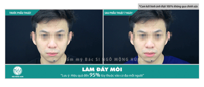 Phẫu thuật tạo môi cười