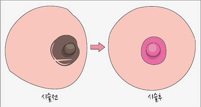 Mẹo làm hồng nhũ hoa tại nhà