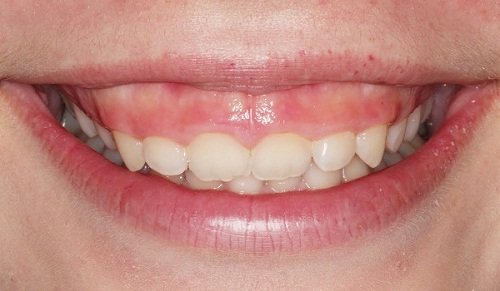 Trẻ em cười hở lợi