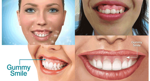 Trẻ em cười hở lợi