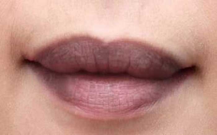 Thẩm mỹ môi hồng