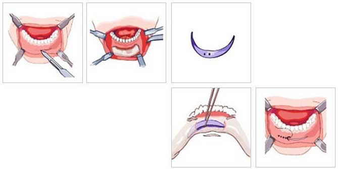 Độn cằm V Line là gì