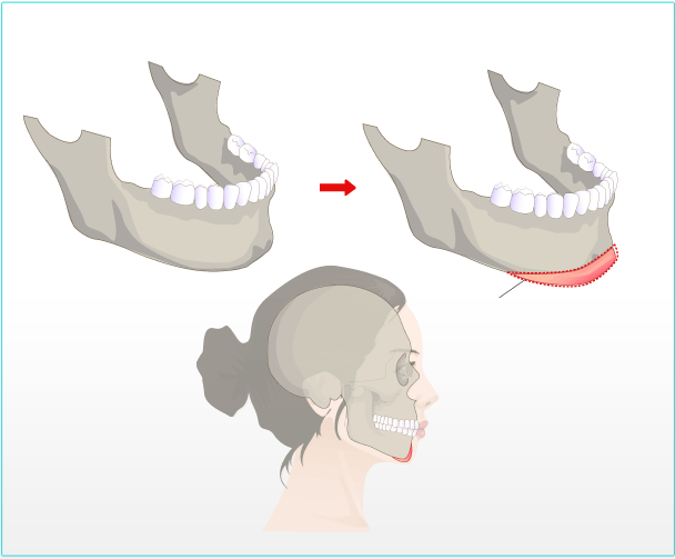 Độn cằm bao lâu thì đẹp